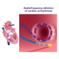Radiofrequency catheter ablation of the heart. Royalty Free Stock Photo